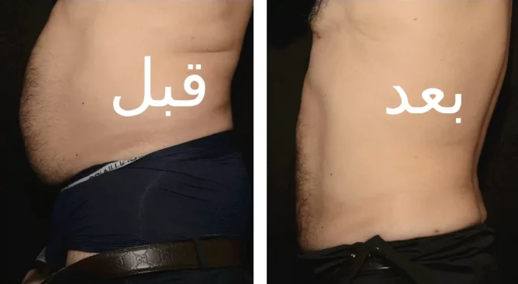 أفضل دكتور شفط دهون بالفيزر في مصر
