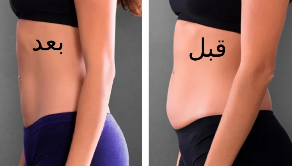 عملية نحت الجسم قبل وبعد
