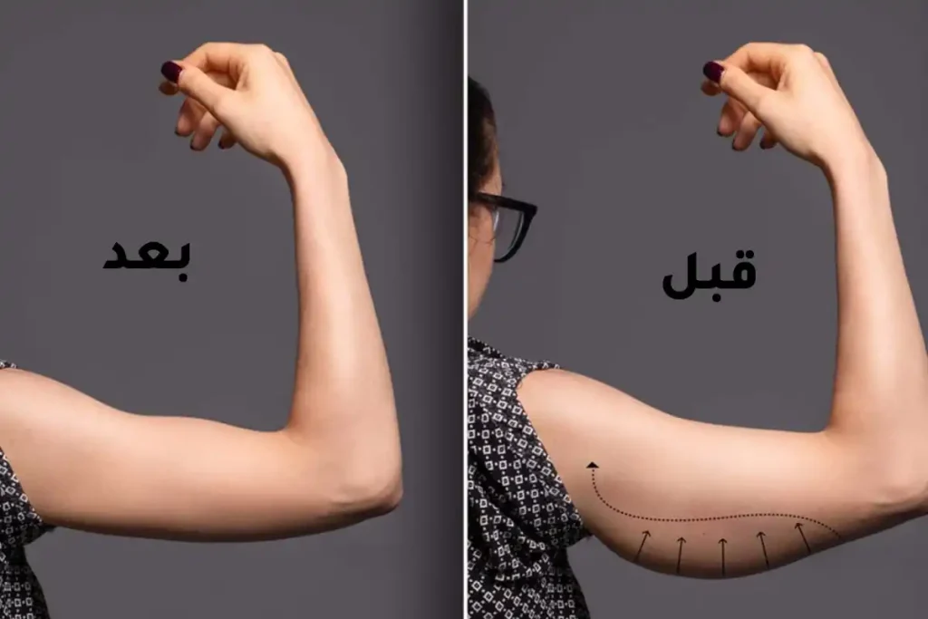 تظهر نتائج شد ترهلات بالليزر تدريجيًا على مدار ثلاثة إلى ستة أشهر