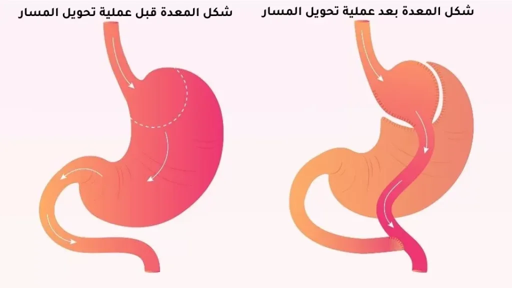 توضح هذه الصورة شكل المعدة قبل وبعد عملية تحويل مسار المعدة