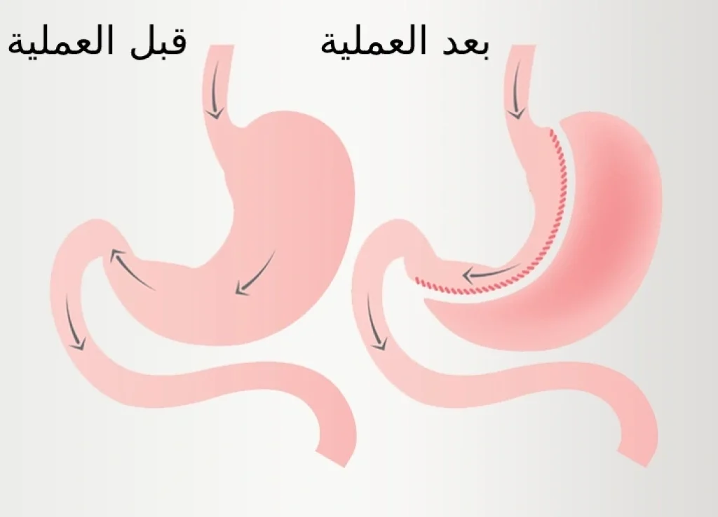 حجم المعدة قبل وبعد عملية التكميم المعدة بالمنظار